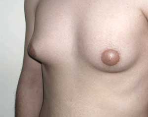 Гинекомастия. Гинекомастия.