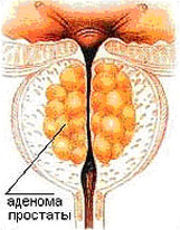 Аденома простаты.