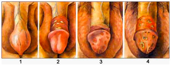 Воспаление кожи головки и крайней плоти полового члена (баланопостит)..