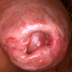 Фимозы при половых инфекциях. Фимозы при половых инфекциях.