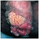 Фимозы при заболеваниях кожи. Фимозы при заболеваниях кожи.