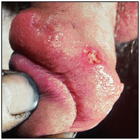 Герпес генитальный.