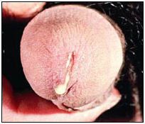 Признаки гонореи.