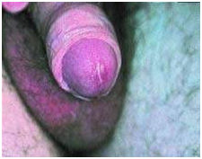 Симптомы хламидиоза.