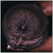 Признаки хламидиоза.