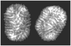 Вирус Контагиозного Моллюска.