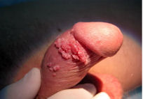 Остроконечные кондиломы, вызванные ВПЧ 6 и 11 типа.