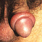 Парафимоз. Парафимоз.