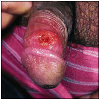 Сифилис, твердые шанкры - 1.