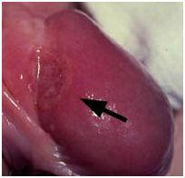 Сифилис, твердые шанкры - 2.