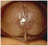 Признаки трихомониаза.