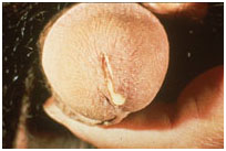 Уретрит. Уретрит.